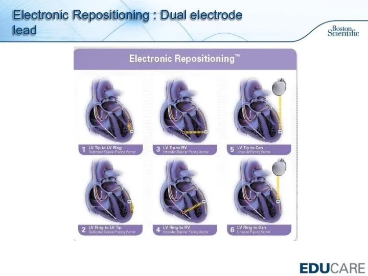 Electronic Repositioning : Dual electrode lead