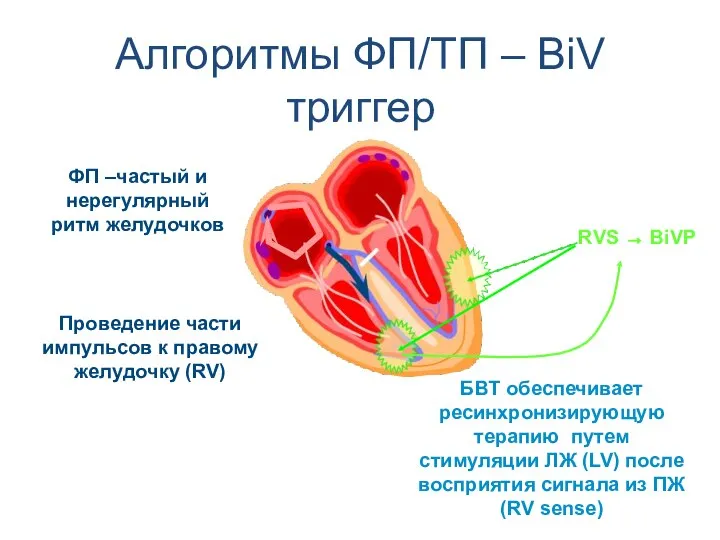 Проведение части импульсов к правому желудочку (RV) БВТ обеспечивает ресинхронизирующую терапию путем