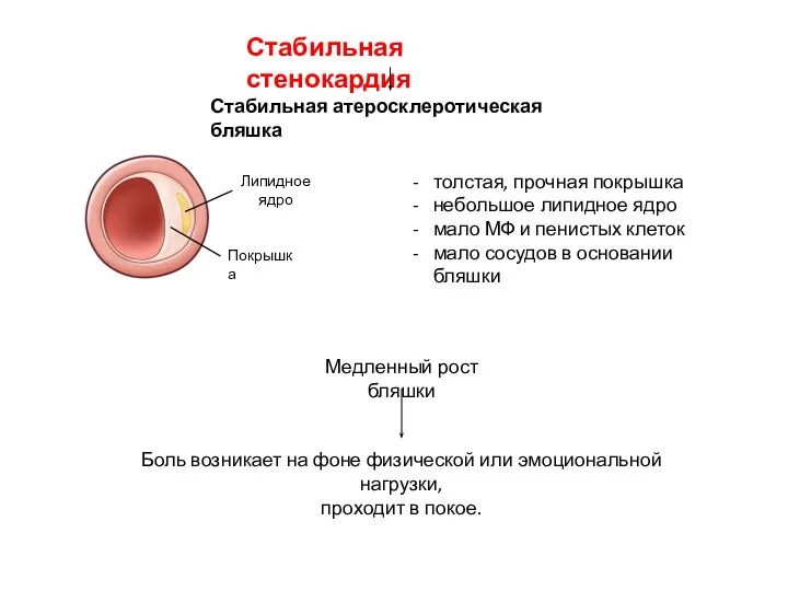 Стабильная атеросклеротическая бляшка Покрышка Липидное ядро толстая, прочная покрышка небольшое липидное ядро