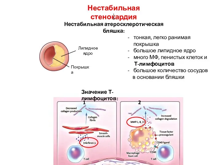 тонкая, легко ранимая покрышка большое липидное ядро много МФ, пенистых клеток и