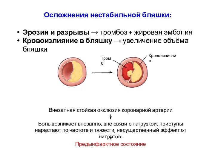 Осложнения нестабильной бляшки: Эрозии и разрывы → тромбоз + жировая эмболия Кровоизлияние