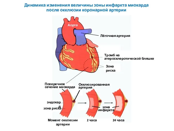 Динамика изменения величины зоны инфаркта миокарда после окклюзии коронарной артерии