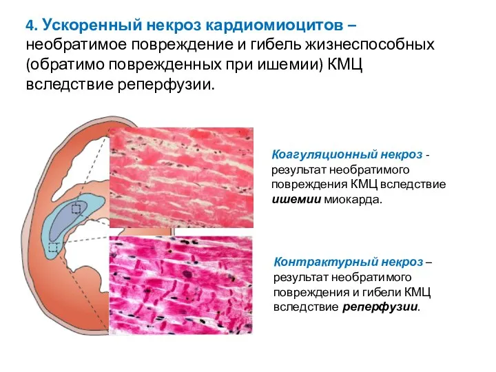 4. Ускоренный некроз кардиомиоцитов – необратимое повреждение и гибель жизнеспособных (обратимо поврежденных