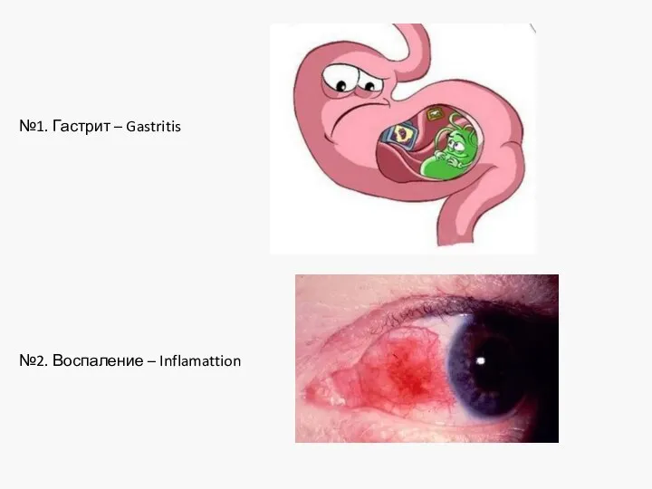 №1. Гастрит – Gastritis №2. Воспаление – Inflamattion