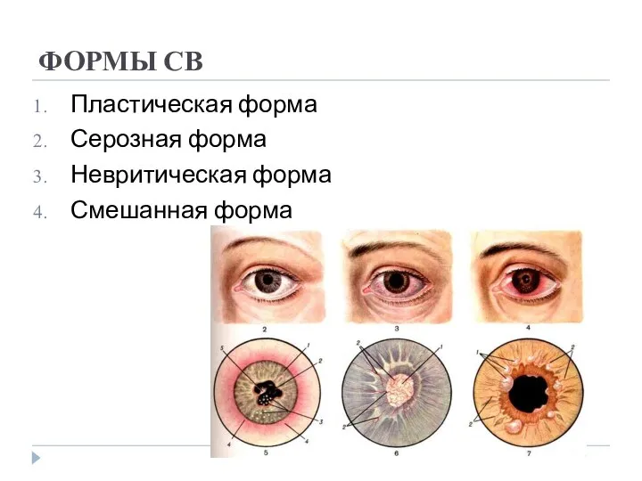 ФОРМЫ СВ Пластическая форма Серозная форма Невритическая форма Смешанная форма