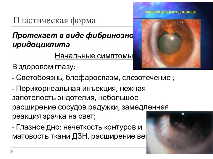 Пластическая форма Протекает в виде фибринозного иридоциклита Начальные симптомы: В здоровом глазу:
