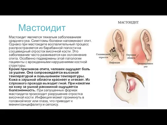 Мастоидит Мастоидит является тяжелым заболеванием среднего уха. Симптомы болезни напоминают отит. Однако