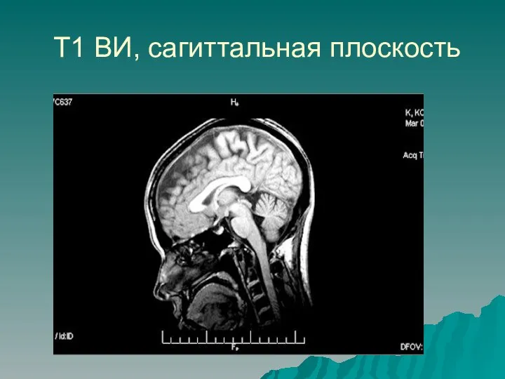 Т1 ВИ, сагиттальная плоскость