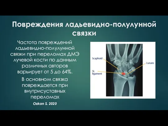 Повреждения ладьевидно-полулунной связки Частота повреждений ладьевидно-полулунной связки при переломах ДМЭ лучевой кости