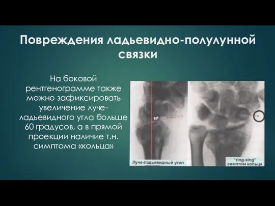 Повреждения ладьевидно-полулунной связки На боковой рентгенограмме также можно зафиксировать увеличение луче-ладьевидного угла