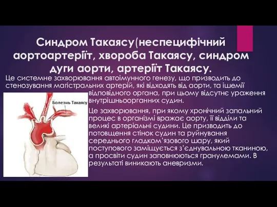 Синдром Такаясу(неспецифічний аортоартеріїт, хвороба Такаясу, синдром дуги аорти, артеріїт Такаясу. Це системне