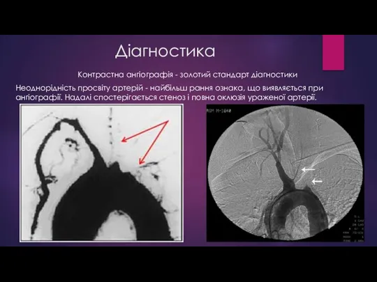 Діагностика Контрастна ангіографія - золотий стандарт діагностики Неоднорідність просвіту артерій - найбільш