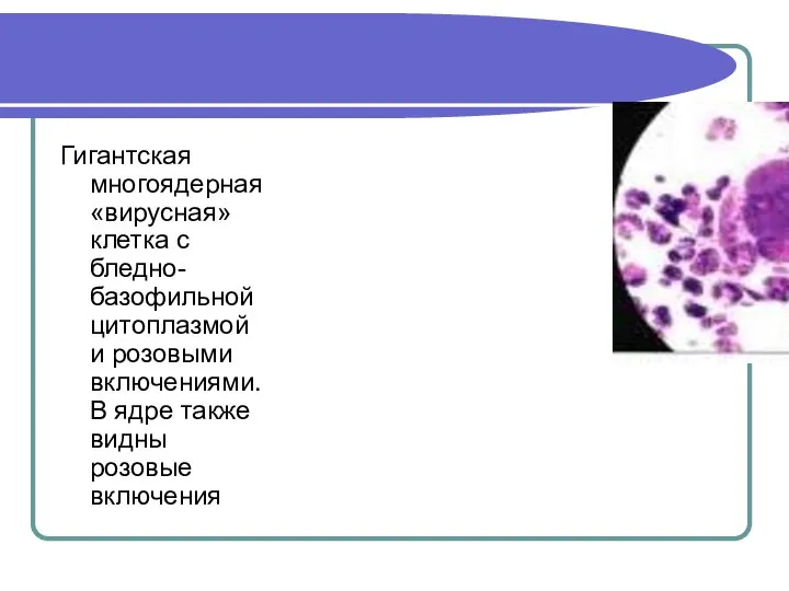 Гигантская многоядерная «вирусная» клетка с бледно-базофильной цитоплазмой и розовыми включениями. В ядре также видны розовые включения