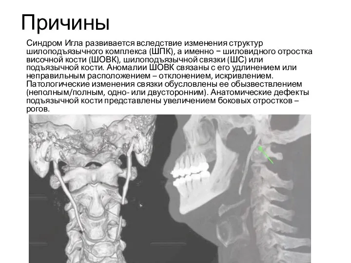 Причины Синдром Игла развивается вследствие изменения структур шилоподъязычного комплекса (ШПК), а именно