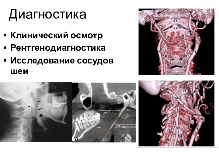 Диагностика Клинический осмотр Рентгенодиагностика Исследование сосудов шеи