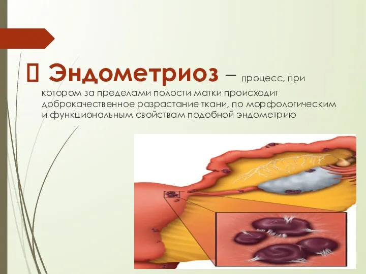 Эндометриоз – процесс, при котором за пределами полости матки происходит доброкачественное разрастание