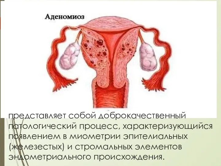 представляет собой доброкачественный патологический процесс, характеризующийся появлением в миометрии эпителиальных (железестых) и стромальных элементов эндометриального происхождения.