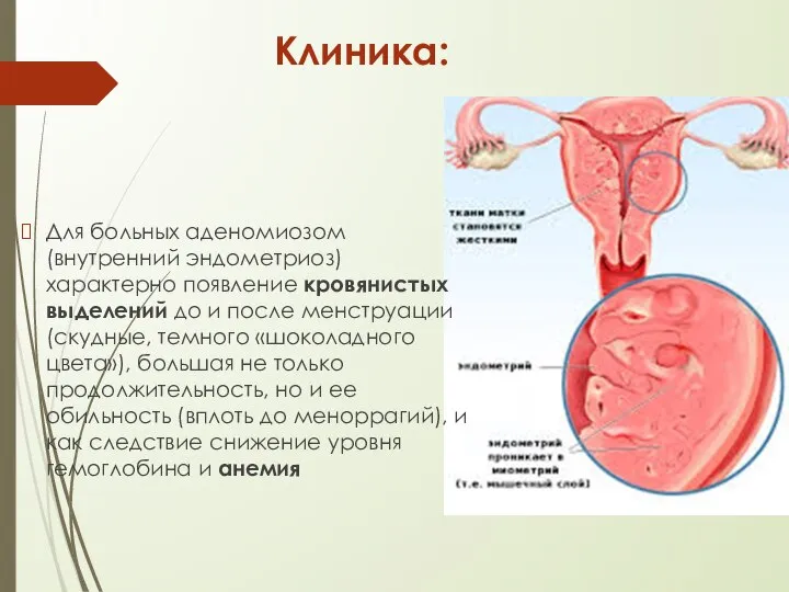 Клиника: Для больных аденомиозом (внутренний эндометриоз) характерно появление кровянистых выделений до и