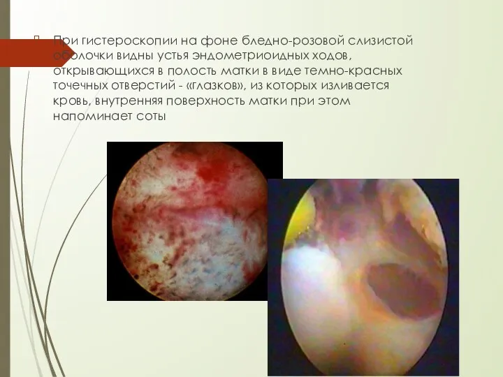 При гистероскопии на фоне бледно-розовой слизистой оболочки видны устья эндометриоидных ходов,открывающихся в