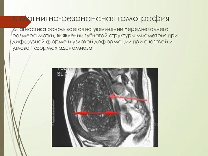 8. Магнитно-резонансная томография Диагностика основывается на увеличении переднезаднего размера матки, выявлении губчатой