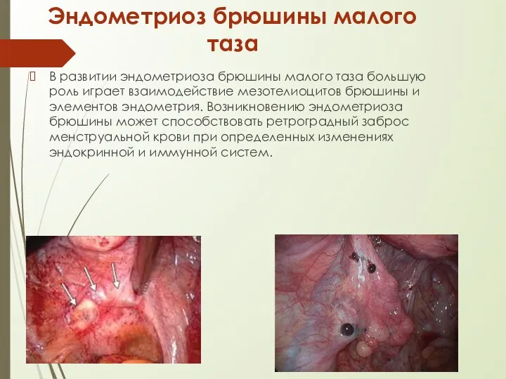 Эндометриоз брюшины малого таза В развитии эндометриоза брюшины малого таза большую роль