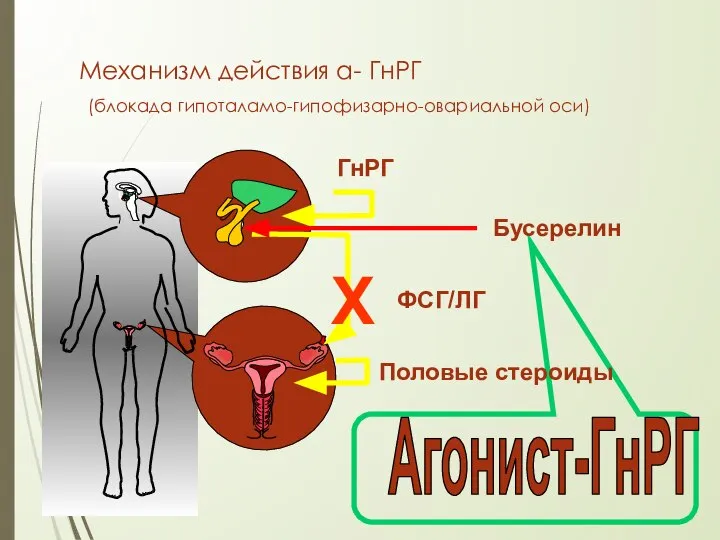 Механизм действия а- ГнРГ (блокада гипоталамо-гипофизарно-овариальной оси) Агонист-ГнРГ Х Бусерелин ГнРГ ФСГ/ЛГ Половые стероиды