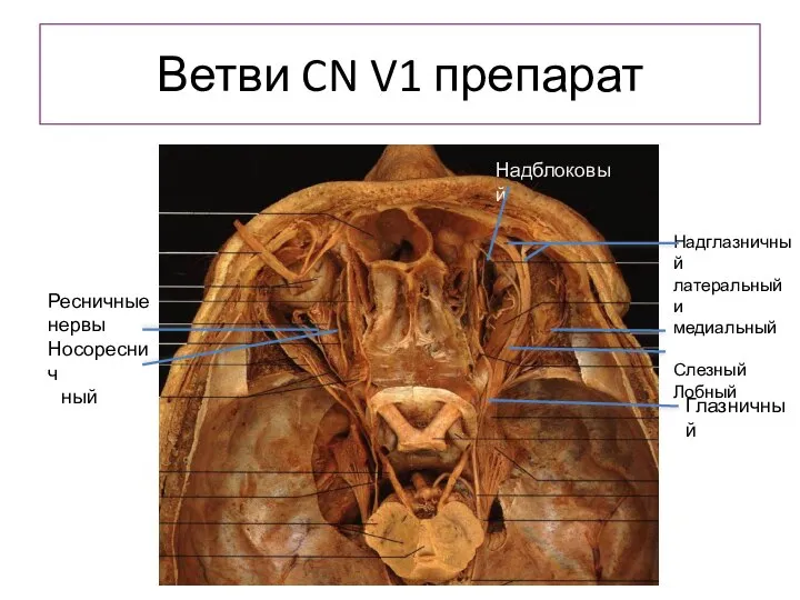 Ветви CN V1 препарат Надглазничный латеральный и медиальный Слезный Лобный Ресничные нервы Носореснич ный Глазничный Надблоковый