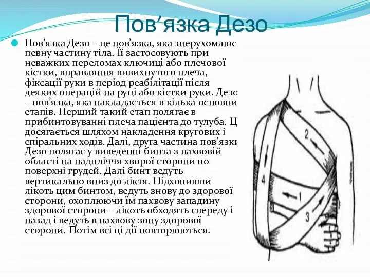 Пов’язка Дезо Пов’язка Дезо – це пов’язка, яка знерухомлює певну частину тіла.