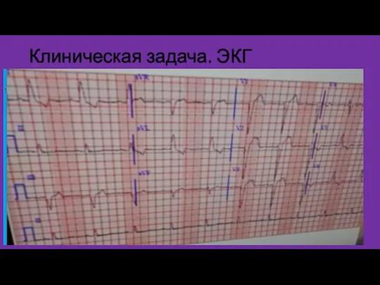 Клиническая задача. ЭКГ