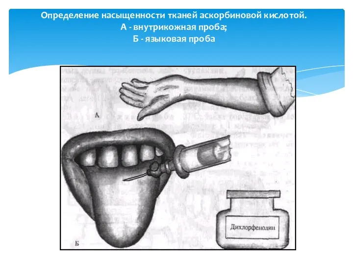 Определение насыщенности тканей аскорбиновой кислотой. А - внутрикожная проба; Б - языковая проба