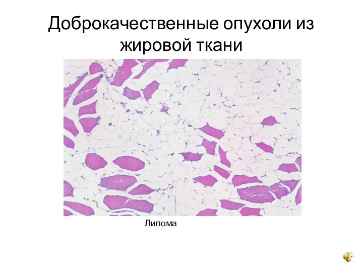 Доброкачественные опухоли из жировой ткани Липома