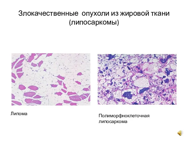 Злокачественные опухоли из жировой ткани (липосаркомы) Липома Полиморфноклеточная липосаркома