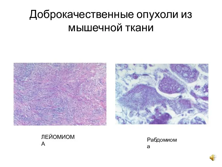 Доброкачественные опухоли из мышечной ткани ЛЕЙОМИОМА Рабдомиома