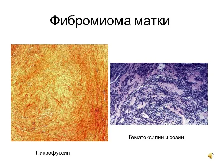 Фибромиома матки Пикрофуксин Гематоксилин и эозин