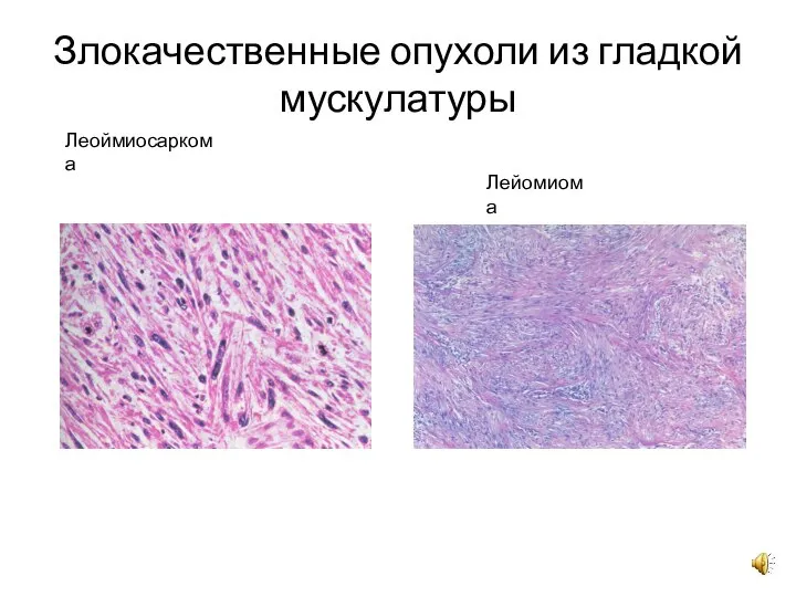 Злокачественные опухоли из гладкой мускулатуры Леоймиосаркома Лейомиома