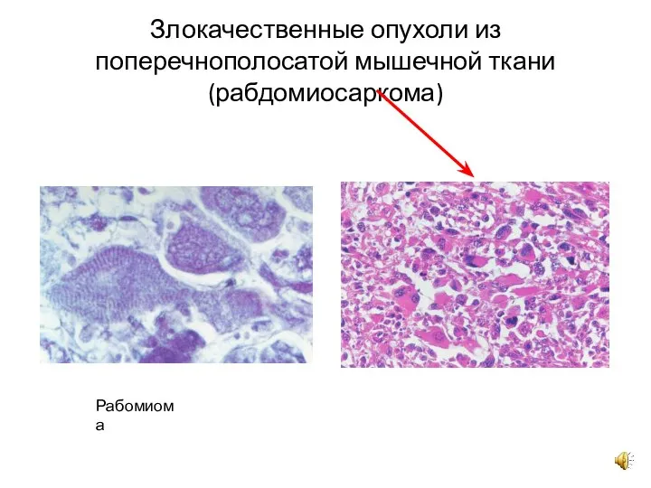 Злокачественные опухоли из поперечнополосатой мышечной ткани (рабдомиосаркома) Рабомиома