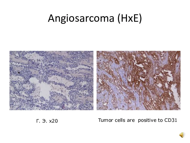 Angiosarcoma (HxE) Г. Э. x20 Tumor cells are positive to CD31