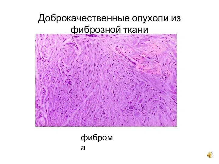 Доброкачественные опухоли из фиброзной ткани фиброма