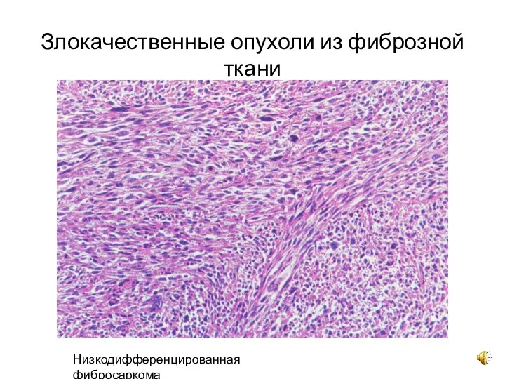Злокачественные опухоли из фиброзной ткани Низкодифференцированная фибросаркома