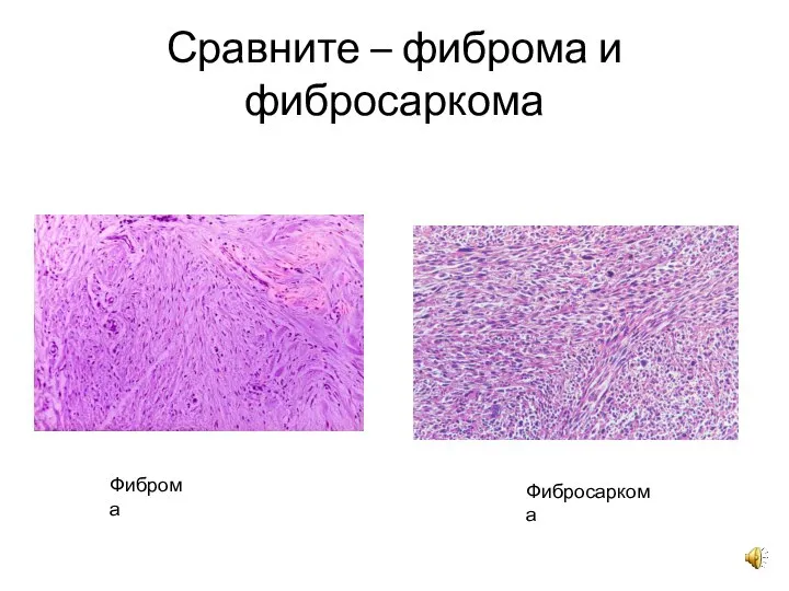 Сравните – фиброма и фибросаркома Фиброма Фибросаркома