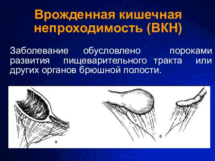 Врожденная кишечная непроходимость (ВКН) Заболевание обусловлено пороками развития пищеварительного тракта или других органов брюшной полости.