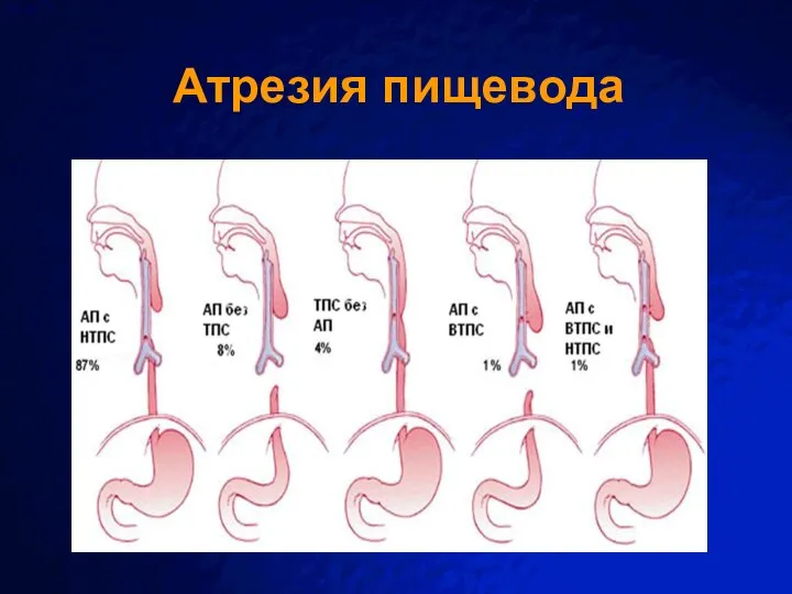 Атрезия пищевода