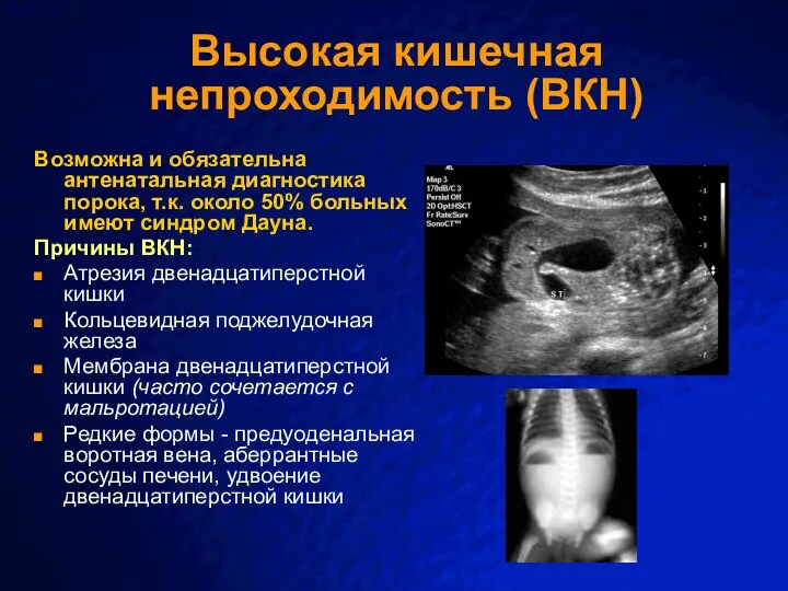 Высокая кишечная непроходимость (ВКН) Возможна и обязательна антенатальная диагностика порока, т.к. около