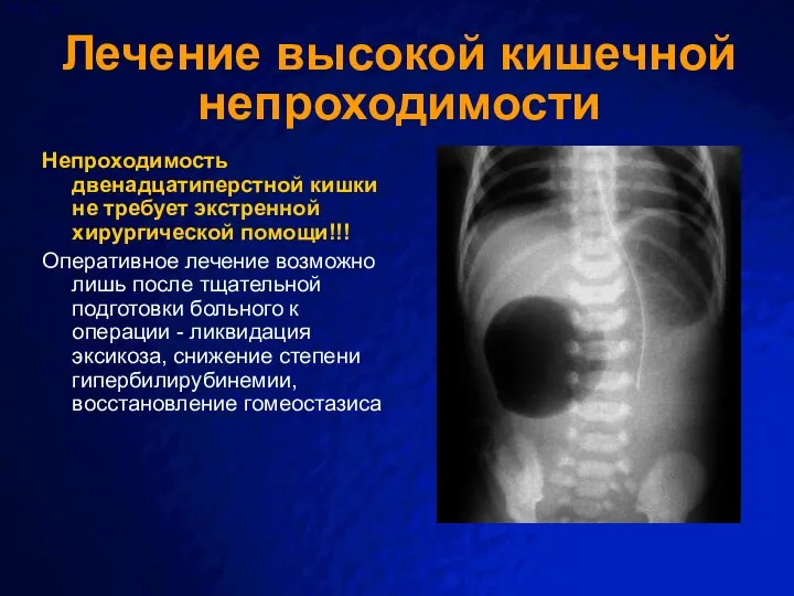 Лечение высокой кишечной непроходимости Непроходимость двенадцатиперстной кишки не требует экстренной хирургической помощи!!!