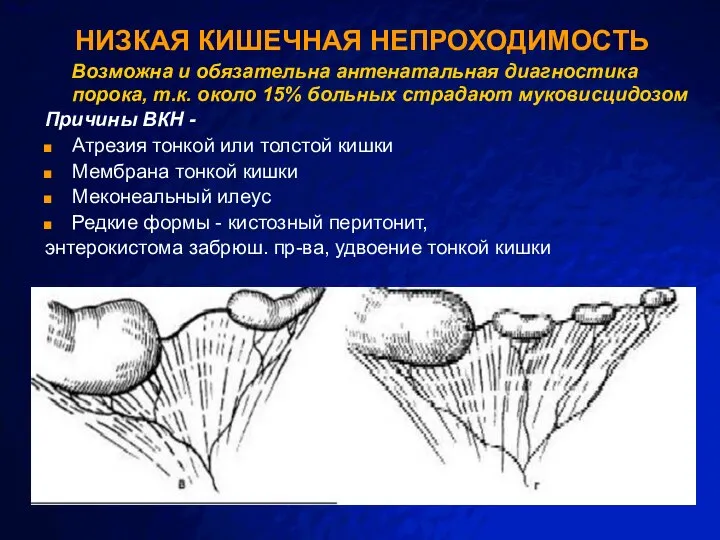 НИЗКАЯ КИШЕЧНАЯ НЕПРОХОДИМОСТЬ Возможна и обязательна антенатальная диагностика порока, т.к. около 15%