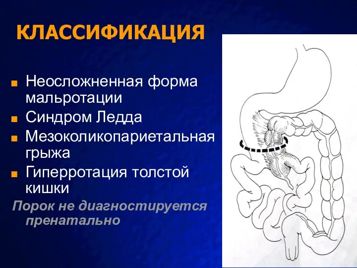 КЛАССИФИКАЦИЯ Неосложненная форма мальротации Синдром Ледда Мезоколикопариетальная грыжа Гиперротация толстой кишки Порок не диагностируется пренатально