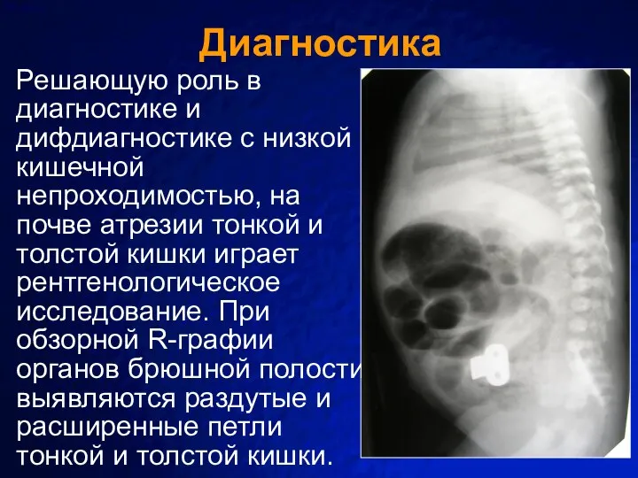 Диагностика Решающую роль в диагностике и дифдиагностике с низкой кишечной непроходимостью, на