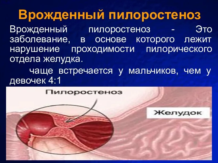 Врожденный пилоростеноз Врожденный пилоростеноз - Это заболевание, в основе которого лежит нарушение