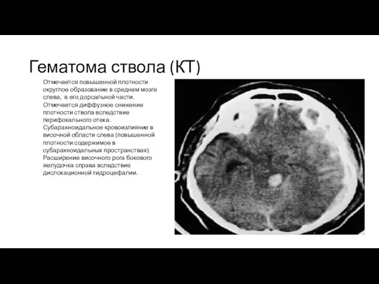 Гематома ствола (КТ) Отмечается повышенной плотности округлое образование в среднем мозге слева,