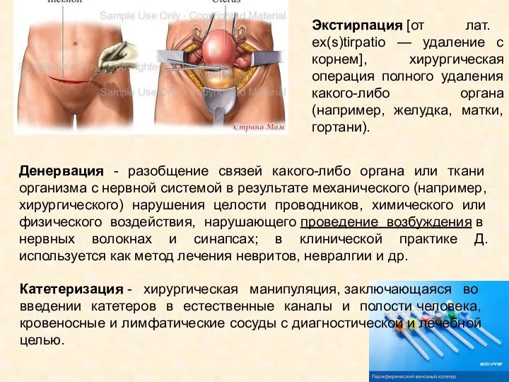 Экстирпация [от лат. ex(s)tirpatio — удаление с корнем], хирургическая операция полного удаления